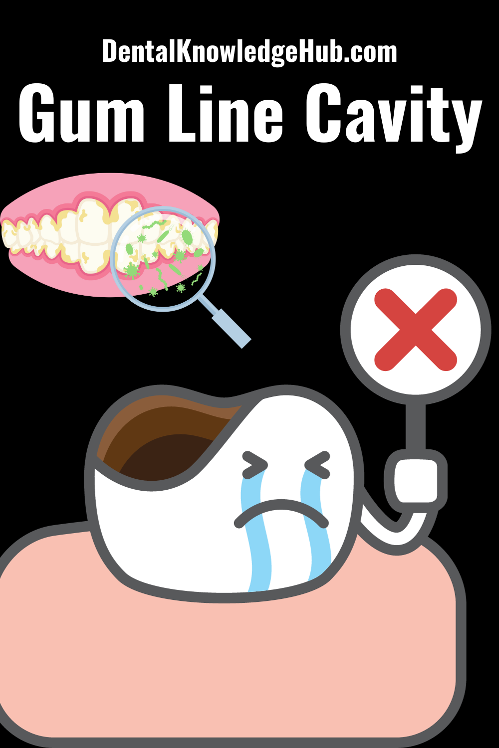 Gum Line Cavity - Dental Knowledge Hub